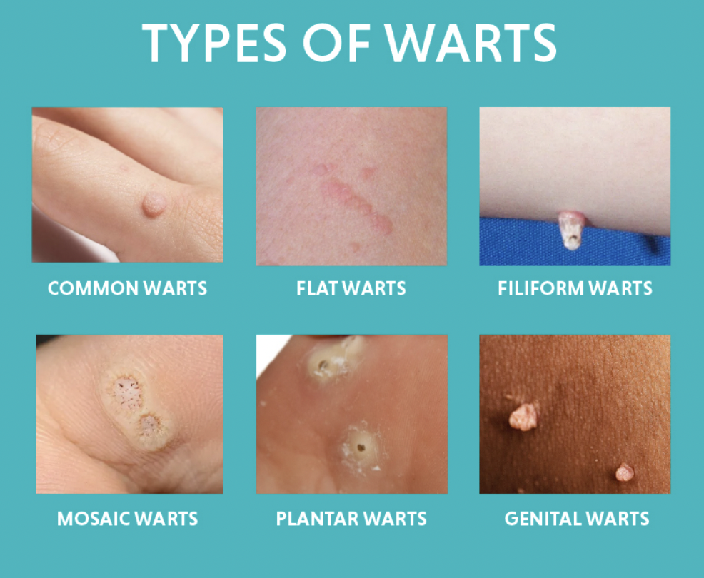 Visual guide to different wart types.