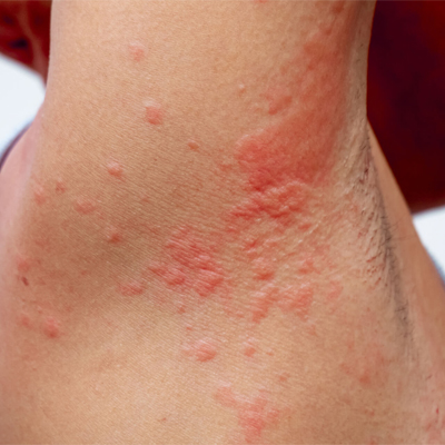 How to Manage Eczema: Top Treatment Options – Dermatology North Sydney