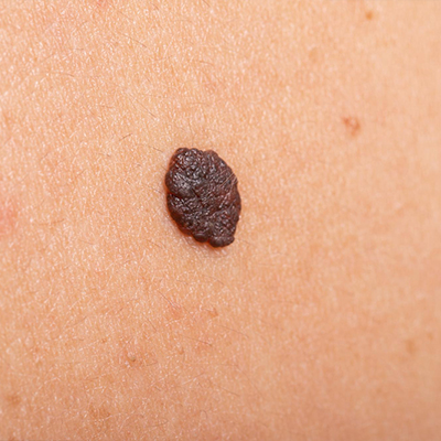 Mole Removal Explained: From Diagnosis to Treatment – Dermatology North ...